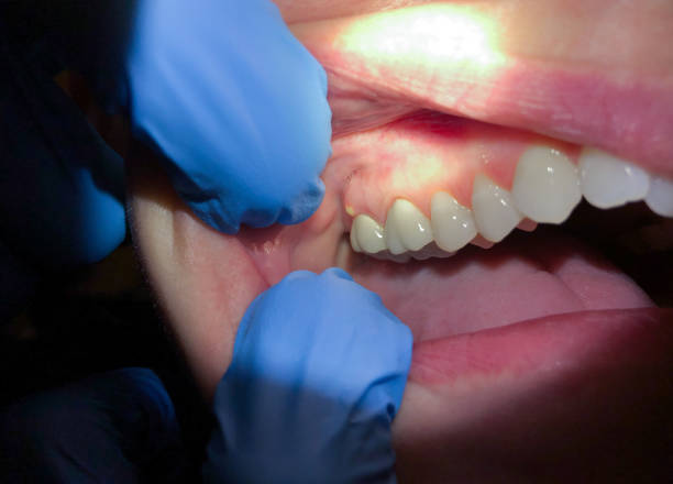 Best Emergency Dental Care for Broken or Chipped Teeth in Pendleton, OR